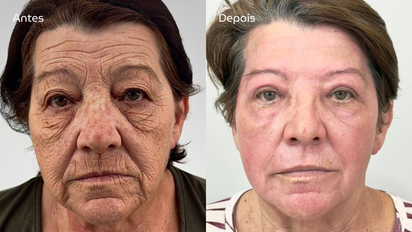 Imagem Renova Peeling Facial